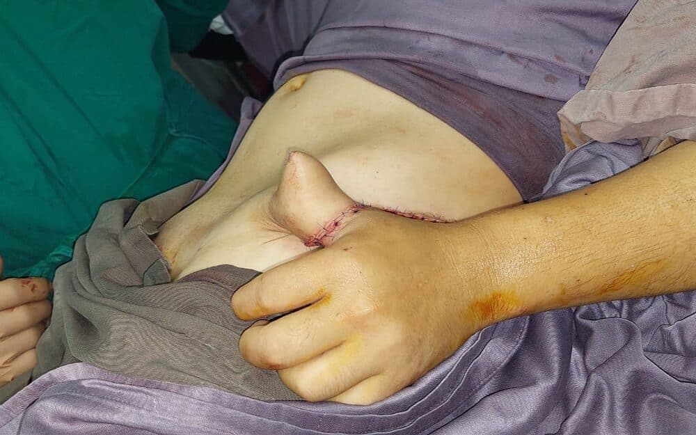 Staged groin flap for a degloved dorsum of the hand