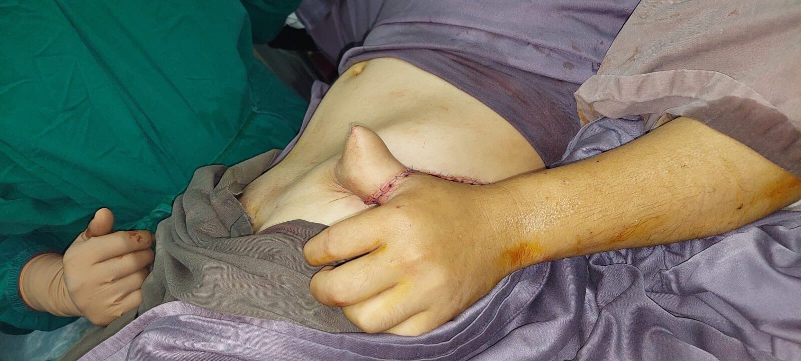 Hand after the groin flap pedicle has been divided and inset completed.