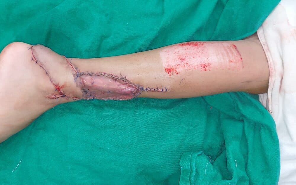 Reverse sural artery flap for an exposed Achilles tendon