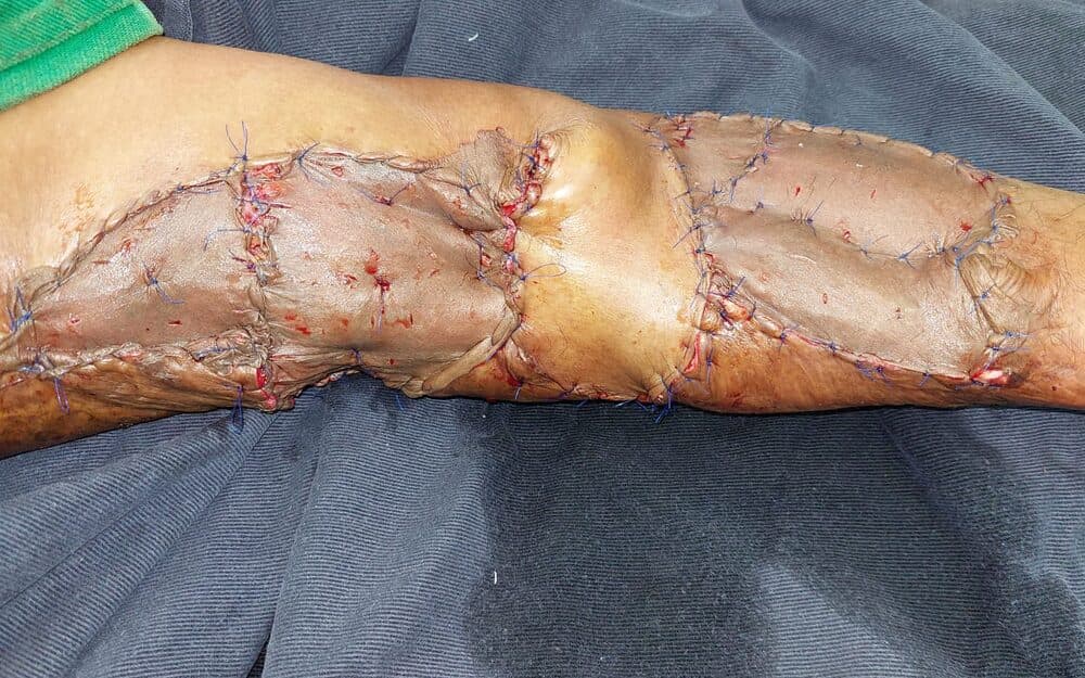 Soft-tissue cover of an open tibial fracture held on an external fixator