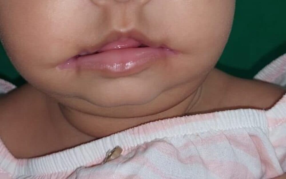 Primary repair of a unilateral cleft lip in an infant