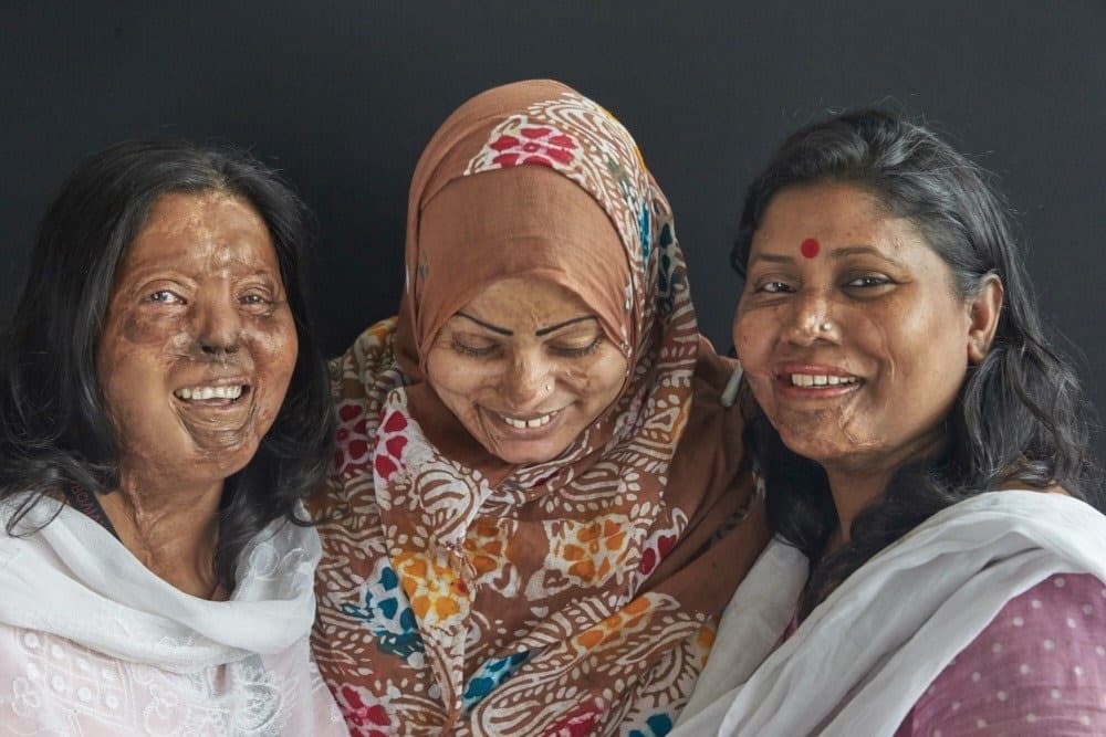 Three burn survivors smiling together