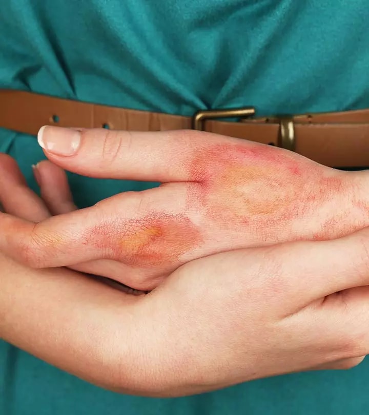 13-Remedies-To-Treat-Burns
