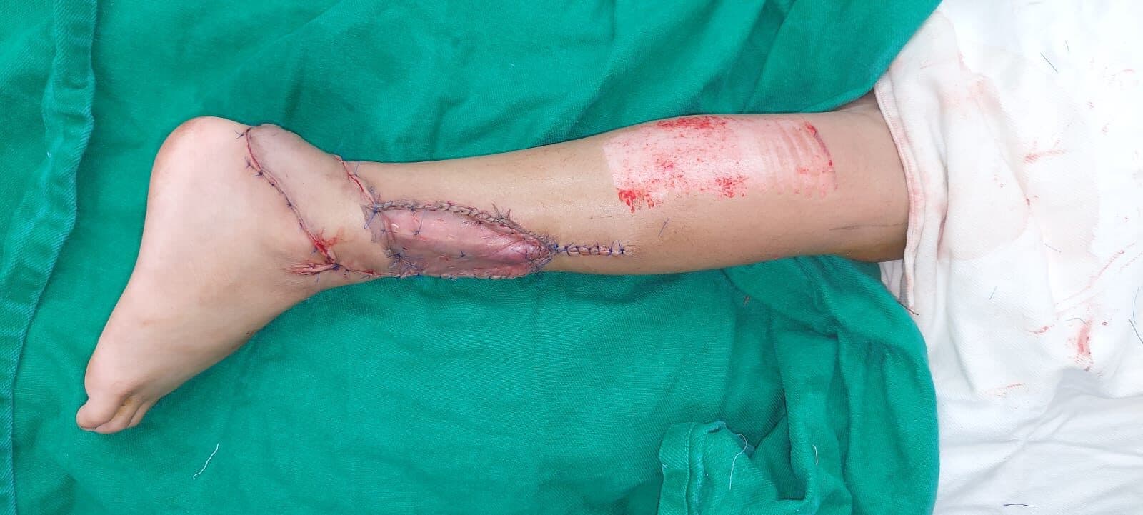 Healed inset of a reverse sural flap over the ankle.