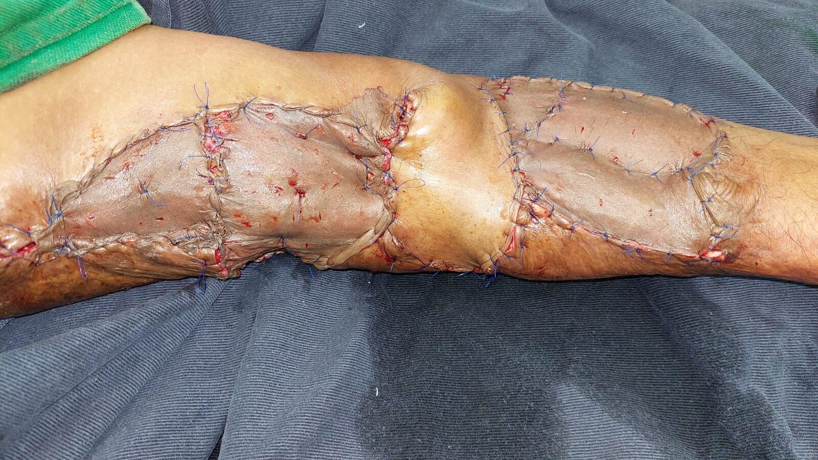 Lower limb resurfaced and healed following staged reconstruction.