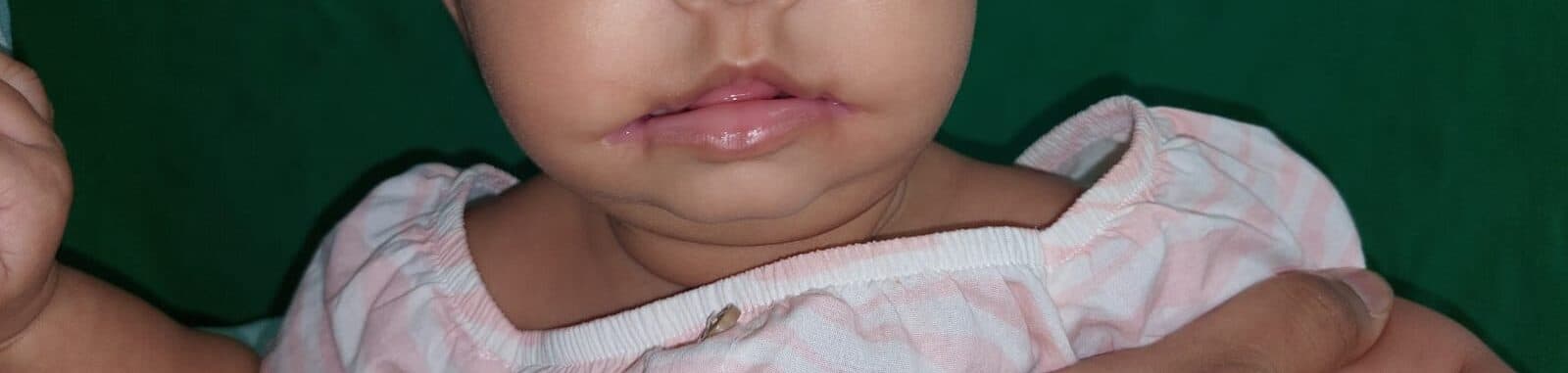 Healed cleft lip repair, cropped to the lower face.